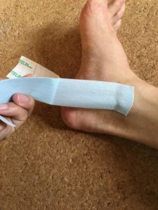 オーバープロネーション、テーピング